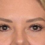 Blepharoplasty Before & After Patient #3271