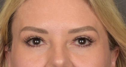 Blepharoplasty Before & After Patient #3271