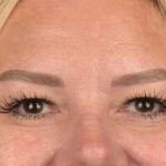 Blepharoplasty Before & After Patient #3271