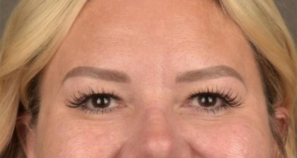 Blepharoplasty Before & After Patient #3271