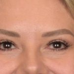 Blepharoplasty Before & After Patient #3271