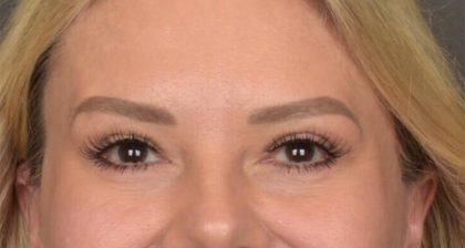 Blepharoplasty Before & After Patient #3271