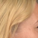 Blepharoplasty Before & After Patient #3271