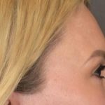 Blepharoplasty Before & After Patient #3271