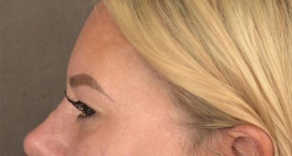 Blepharoplasty Before & After Patient #3271