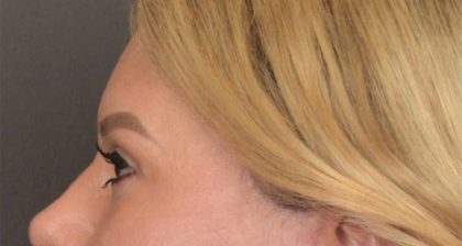 Blepharoplasty Before & After Patient #3271