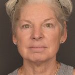 Facelift Before & After Patient #3466