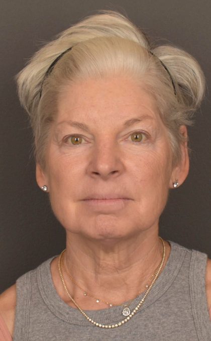 Facelift Before & After Patient #3466
