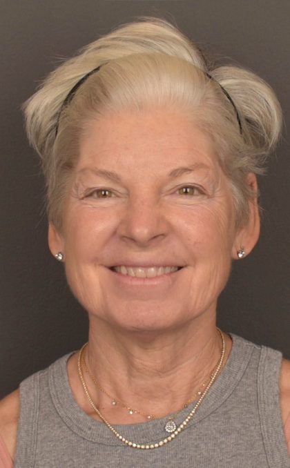 Facelift Before & After Patient #3466