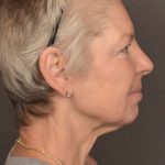 Facelift Before & After Patient #3466