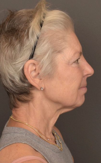 Facelift Before & After Patient #3466