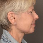 Facelift Before & After Patient #3466