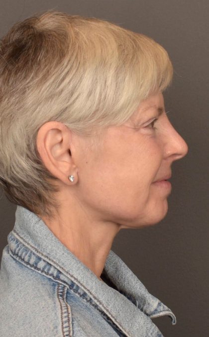 Facelift Before & After Patient #3466