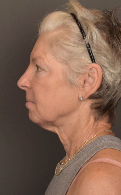 Facelift Before & After Patient #3466
