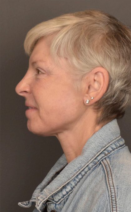 Facelift Before & After Patient #3466