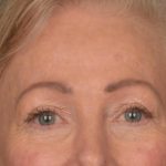 Brow Lift Before & After Patient #3288