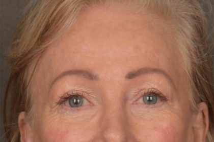 Brow Lift Before & After Patient #3288