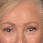 Brow Lift Before & After Patient #3288
