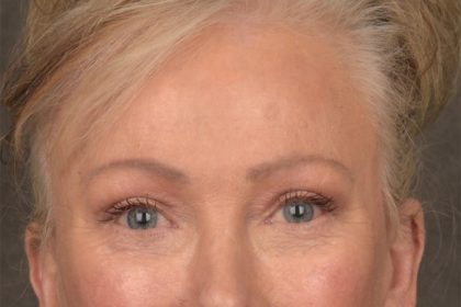 Brow Lift Before & After Patient #3288