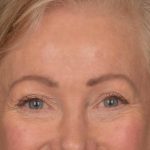 Brow Lift Before & After Patient #3288