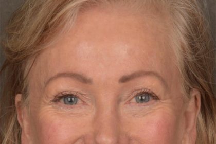Brow Lift Before & After Patient #3288