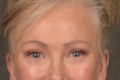 Brow Lift Before & After Patient #3288
