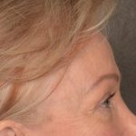 Brow Lift Before & After Patient #3288