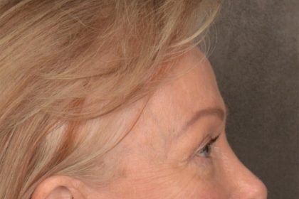 Brow Lift Before & After Patient #3288