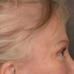 Brow Lift Before & After Patient #3288
