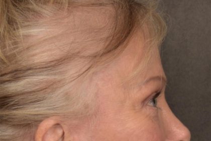 Brow Lift Before & After Patient #3288