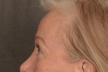 Brow Lift Before & After Patient #3288