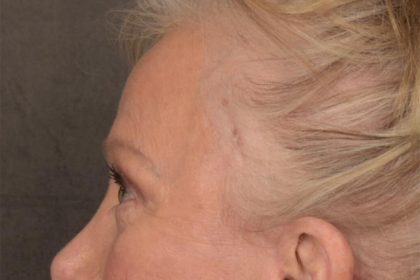 Brow Lift Before & After Patient #3288