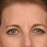 Brow Lift Before & After Patient #3289