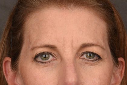 Brow Lift Before & After Patient #3289