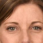 Brow Lift Before & After Patient #3289