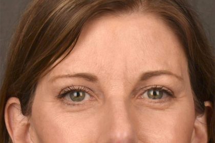 Brow Lift Before & After Patient #3289