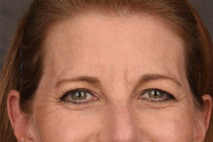 Brow Lift Before & After Patient #3289