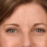 Brow Lift Before & After Patient #3289