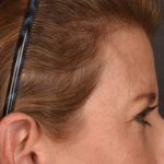 Brow Lift Before & After Patient #3289