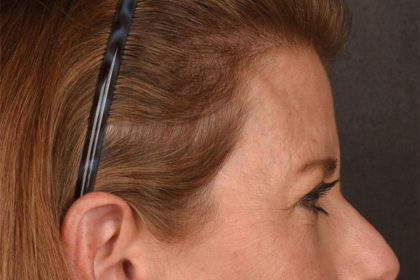 Brow Lift Before & After Patient #3289