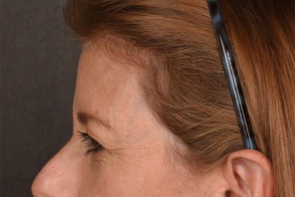Brow Lift Before & After Patient #3289