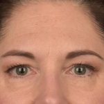 Brow Lift Before & After Patient #3291
