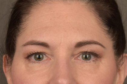 Brow Lift Before & After Patient #3291