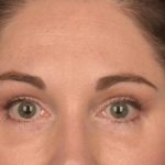 Brow Lift Before & After Patient #3291
