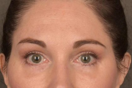 Brow Lift Before & After Patient #3291