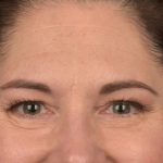 Brow Lift Before & After Patient #3291