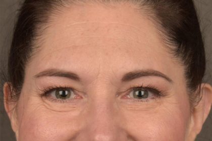 Brow Lift Before & After Patient #3291