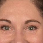 Brow Lift Before & After Patient #3291