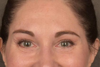 Brow Lift Before & After Patient #3291