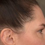 Brow Lift Before & After Patient #3291